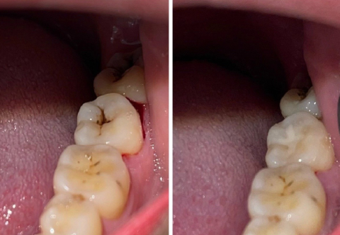 [BẬT MÍ] Hàn răng sâu không đau, 10 phút xong